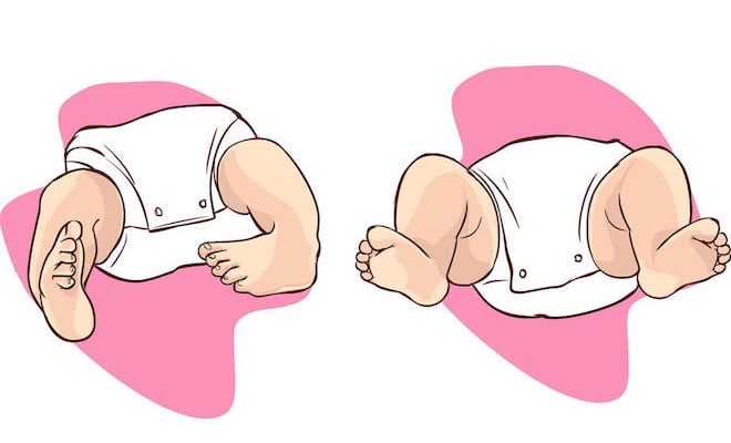 piede-equino-neonato